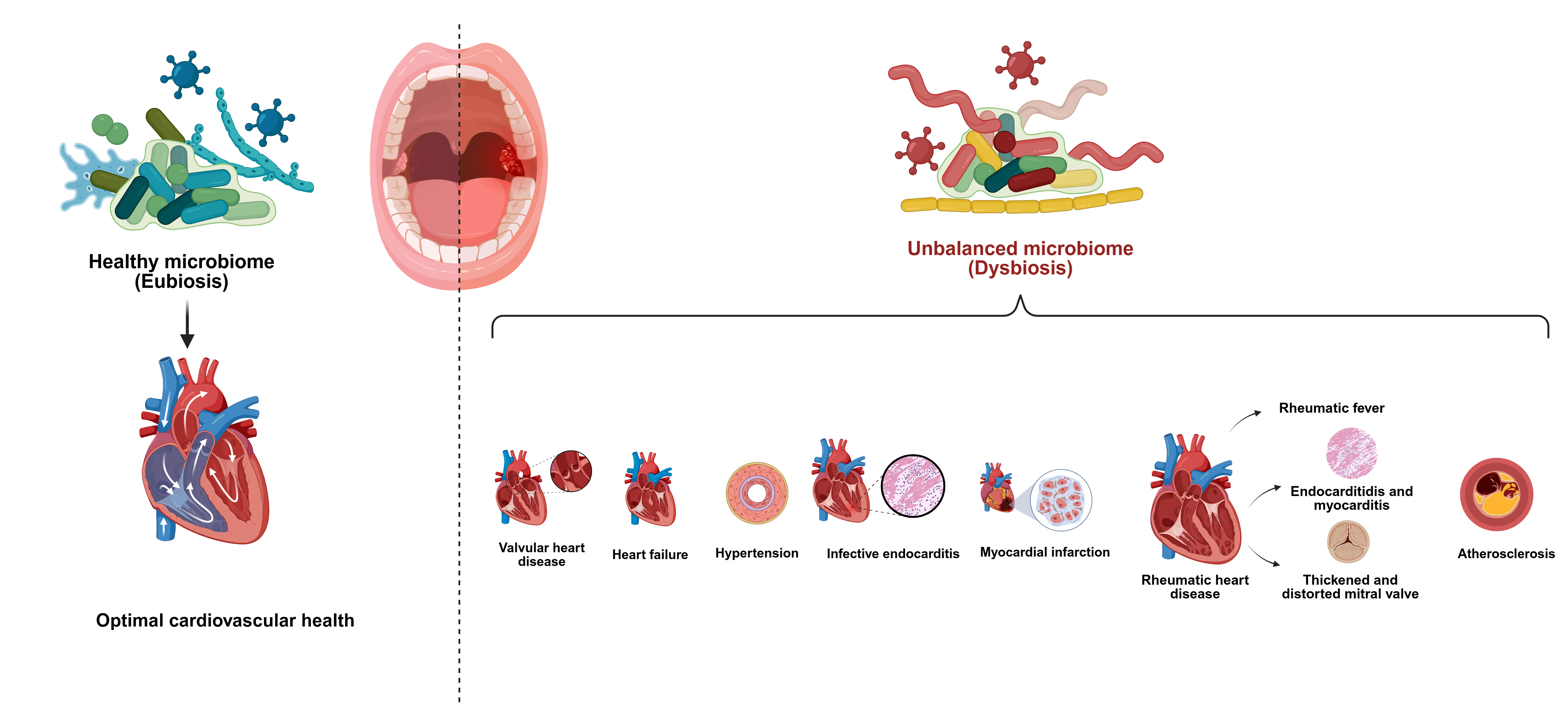 Mouth-heart axis: contribution of oral dysbiotic bacteria in the initiation and development of cardiovascular conditions thumbnail